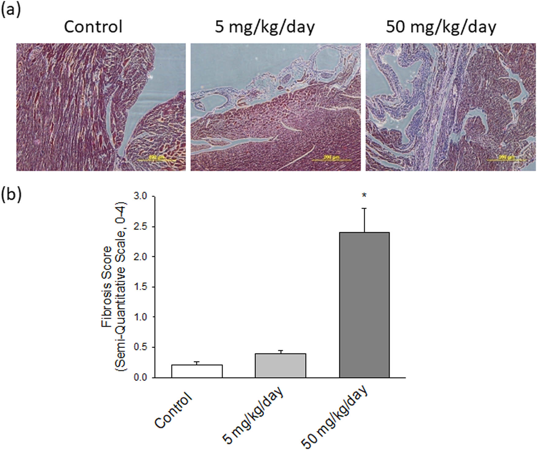 Figure 3 
                  (a) Pathological changes in the left ventricles of experimental rats. MT staining of cardiac tissues from control, low-dosage arecoline, and high-dosage arecoline rats. Collagen accumulation is shown in blue. The myocardial architecture images were magnified at ×400. The scale bar is 200 µm. (b) Semiquantitative grade morphormetric fibrosis scoring for trichrome slides of left ventricular cardiac section. * Significant difference (P < 0.05).
               