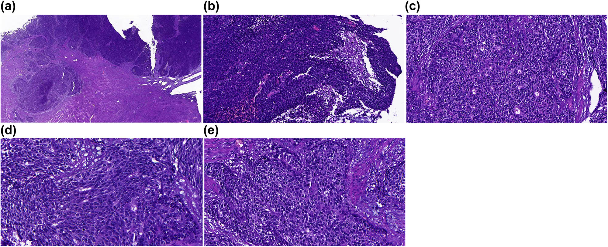Figure 2 
                  HE staining of the samples. (a) Cancer cells were arranged in a nest or lamellar pattern. Infiltrative growth was noticed in the myometrium. (b) Necrosis in the cancer tissues. (c) Small glandular duct-like and rosettes-like structures. (d) Multiple mitotic phases. (e) Cancer cells with less cytoplasm, and deep staining in nucleus. Part of the cancer cells showed a small nucleus. Magnifications of the images were as follows: (a) 40×; (b and c) 200×; (d and e) 400×.
               