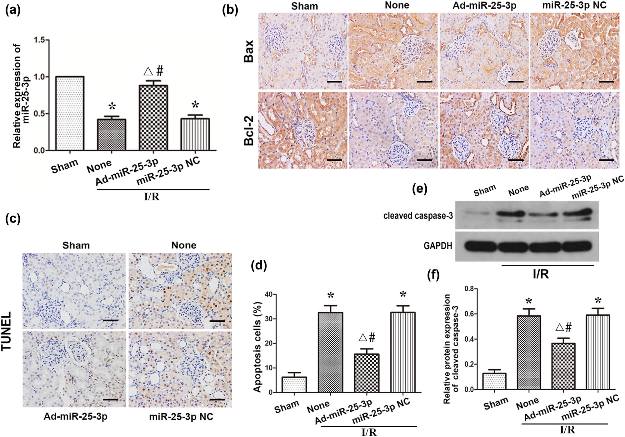 Figure 5 
                  Overexpression of miR-25-3p in animals can reduce apoptosis during renal IRI. (a) The expression level of miR-25-3p in normal kidney and adenovirus-transfected kidney tissue. (b) Immunohistochemistry analysis of the Bax and Bcl-2 protein expression levels in kidney tissues from each group. The brown cells indicated by the black arrow are positively stained. Scale bar, 50 µm. (c) TUNEL staining of kidney tissues from each group. The brown-black cells indicated by the black arrows are TUNEL positive. Scale bar, 50 µm. (d) Quantitative analysis of the percentage of TUNEL-positive cells in each group. (e) Expression levels of cleaved caspase-3 in each group. (f) Quantitative values of the relative expression levels of cleaved caspase-3 proteins in each group. The data are expressed as the mean ± SD. * P < 0.05 versus the sham group, ΔP < 0.05 versus the I/R + None group, #
                     P < 0.05 versus the I/R + miR-25-3p NC group.
               