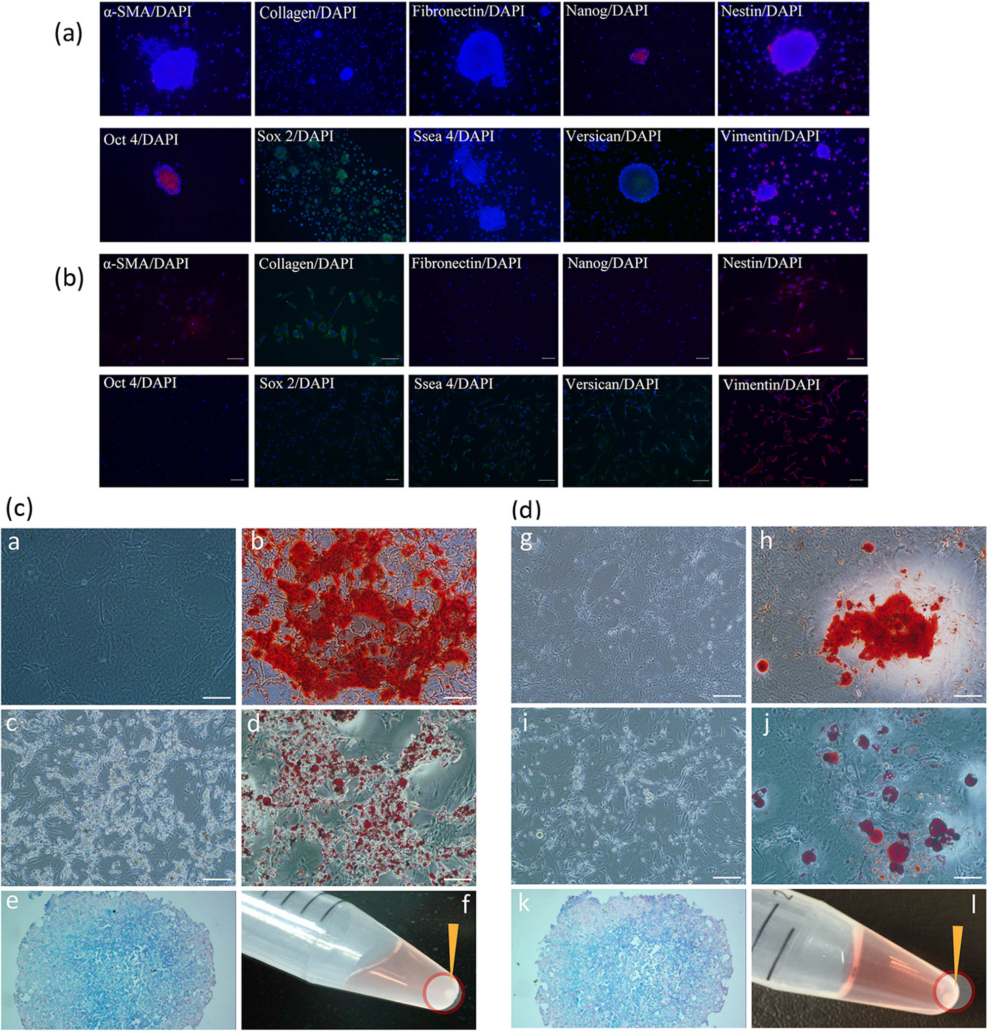 Figure 5 
                  Results of immunocytochemistry and induced differentiation of cells obtained from culture condition A or B. (a) The spheres obtained from culture condition A expressed α-SMA, Nanog, Nestin, Oct4, Sox2, Ssea4, Versican, and Vimentin; (b) the adherent cells obtained from culture condition B expressed α-SMA, Collagen I, Nestin, Sox2 (weak positive), Ssea4, Versican, and Vimentin; (c) osteocyte-, adipocyte-, and chondrocyte-induced differentiation of spheres obtained from culture condition A; (d) osteocyte-, adipocyte-, and chondrocyte-induced differentiation of adherent cell colonies obtained from culture condition B. ((a and g) Osteocyte calcified matrix (osteogenesis, day 28); (b and h) alizarin red stain (day 28); (c and i) adipocyte lipid droplets (adipogenesis, day 28); (d and j) oil red stain (day 28); (e and k) alcian blue stain, pellets consisted of chondrocytes glycosaminoglycan (chondrogenesis, day 30); (f and l) chondrogenic pellets formed at the bottom of the tubes (indicated by arrowheads, day 30)). Bar: 100 µm.
               
