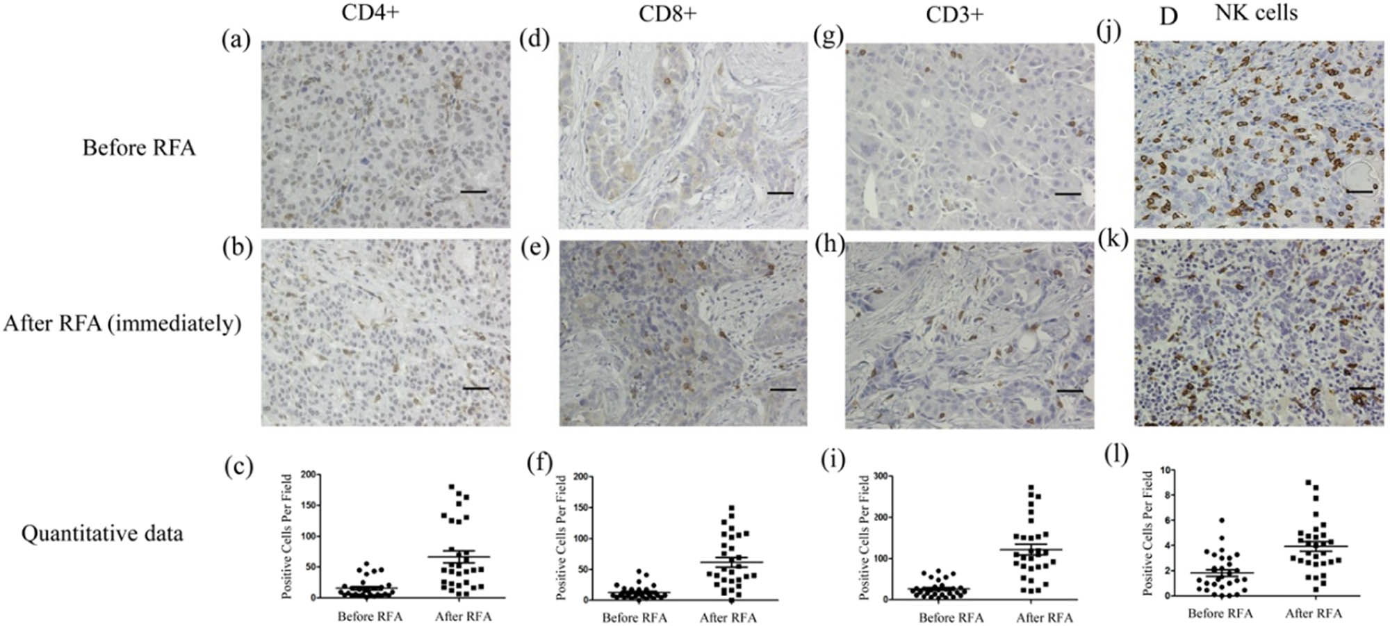 Figure 2
Immunohistochemical assay of immune cells in tumor tissues before and immediately after RFA. Before RFA: (a) CD4+ cells, (d) CD8+ cells, (g) CD3+ cells, and (j) NK cells. Immediately after RFA: (b) CD4+ cells, (e) CD8+ cells, (h) CD3+ cells, and (k) NK cells. Quantitative data: (c) CD4+ cells, (f) CD8+ cells, (i) CD3+ cells, and (l) NK cells. Data are presented as mean ± SEM. The brown cells are positive cells. Bar = 100 µm. RFA: radiofrequency ablation, CD: cluster of differentiation, NK: natural killer, SEM: standard error of the mean.