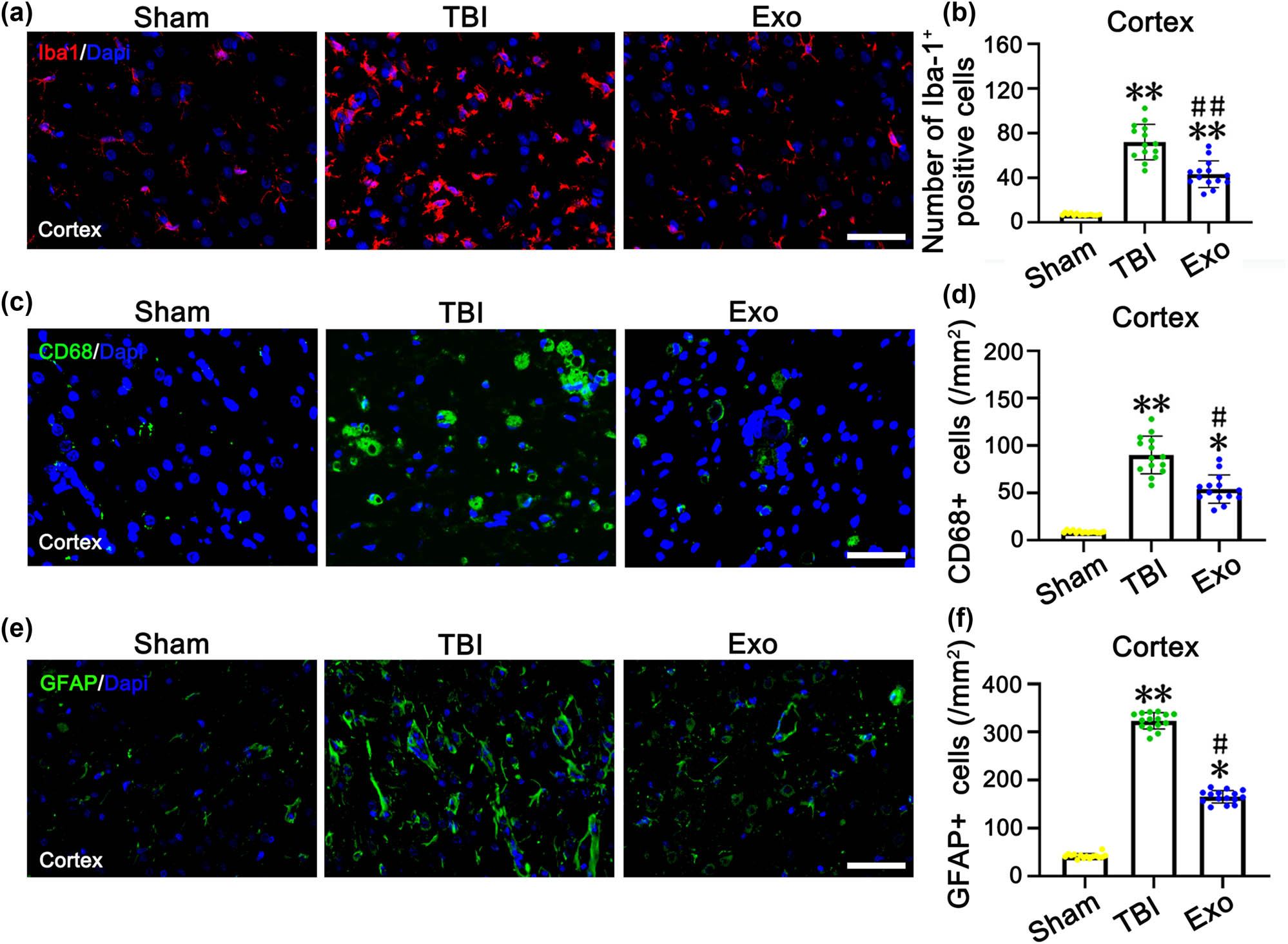 Figure 5
Administration of the HUCMSCs-derived exosomes obviously reduced the number of Iba1, CD68, and GFAP positive cells in the injured cortex of rats at 7 days after TBI. (a, c, and e) Iba1-positive cells (a), CD68-positive cells (c), and GFAP-positive cells (e) in the injured cortex of three groups. (b, d, and f) is the quantification of Iba1 (b), CD68 (d), and GFAP (f) positive cells in each group. *P < 0.05 and **P < 0.01 vs Sham group. #
P < 0.05 and ##
P < 0.01 vs TBI group. Scale bars = 50 µm in panels (a, c, and e).