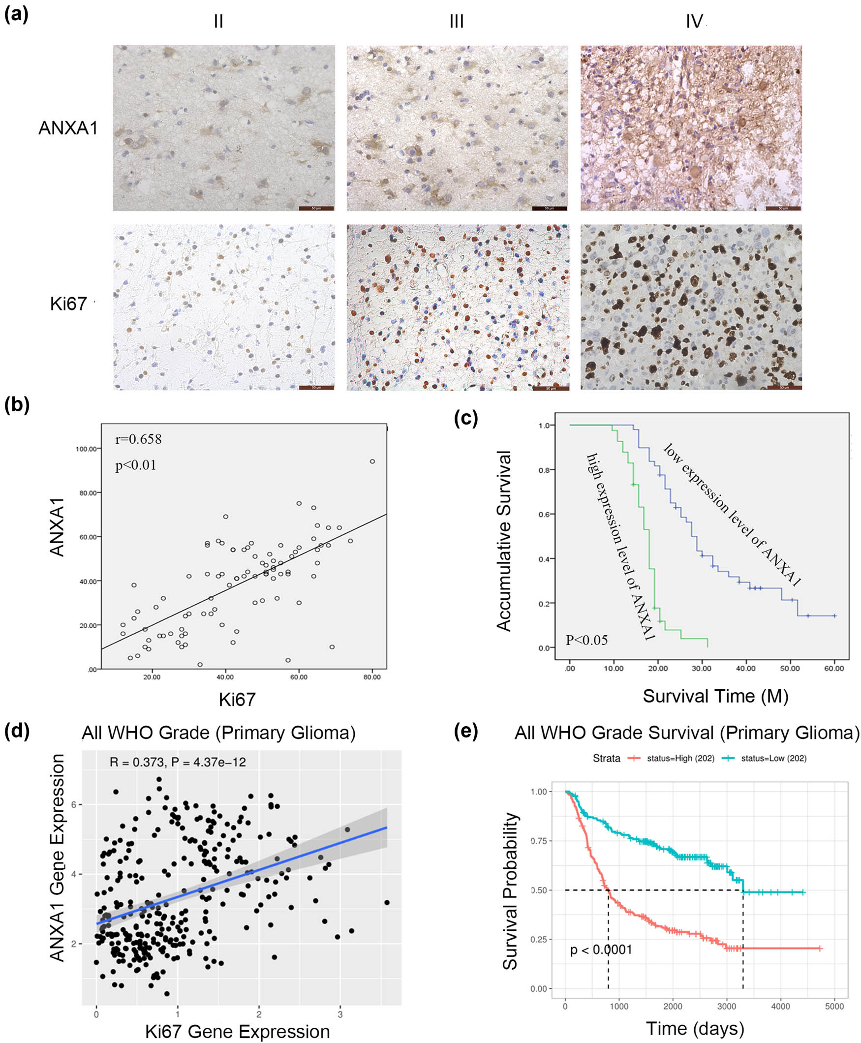 Figure 6 
                  IHC results of ANXA1 expression and univariate analysis of ANXA1 in glioma. (a) Paraffin-embedded glioma tissue sections were stained with anti-ANXA1 antibodies and anti-Ki-67 antibodies followed by counterstaining with haematoxylin (SP × 400). (b) The relationship between ANXA1 and Ki-67 expression by IHC. (c) K–M analysis of ANXA1 in 90 glioma patients. (d) The relationship between ANXA1 and Ki-67 expression based on samples from the CGGA database. (e) K–M analysis of ANXA1 based on samples from the CGGA database.
               