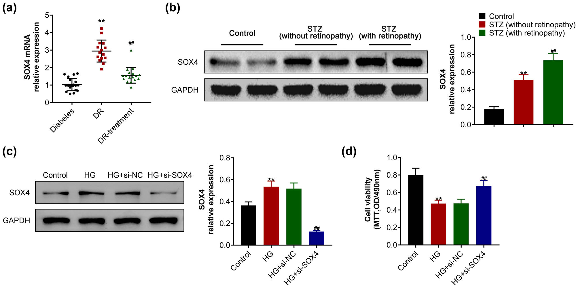 Figure 1 
                  SOX4 was upregulated in DB samples, and its depletion suppressed the viability of high-glucose-induced HRCECs. (a) qPCR assays showed the mRNA level of SOX4 in the peripheral blood monocytes from patients with diabetes, DR, and DR-treatment group. (b) Immunoblot assay showed the expression of SOX4 in mice upon treatment of control, STZ (without retinopathy), and STZ (with retinopathy). (c) Immunoblot assay showed the expression of SOX4 in HRCECs upon the indicated treatment. (d) MTT assay showed the viability of HRCECs upon the indicated treatment. Results are presented as mean ± SEM, HG versus control, **p < 0.01, HG + siSOX4 versus HG + siNC, ##
                     p < 0.01. HG, high glucose, NC, negative control.
               