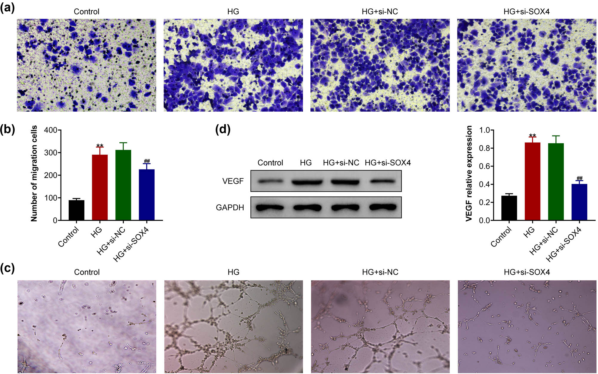 Figure 3 
                  SOX4 depletion suppressed the high-glucose-induced migration and angiogenesis of HRCECs. (a) Transwell assay showed the migration of HRCEC upon the indicated treatment, and (b) the migratory cell numbers were counted. (c) Tube formation assay showed the angiogenesis of HRCECs upon the indicated treatment. (d) Immunoblot assay showed VEGF expression in HRCECs upon the indicated treatment. Results are presented as mean ± SEM, HG versus control, **p < 0.01, HG + siSOX4 versus HG + siNC, ##
                     p < 0.01. HG, high glucose, NC, negative control.
               