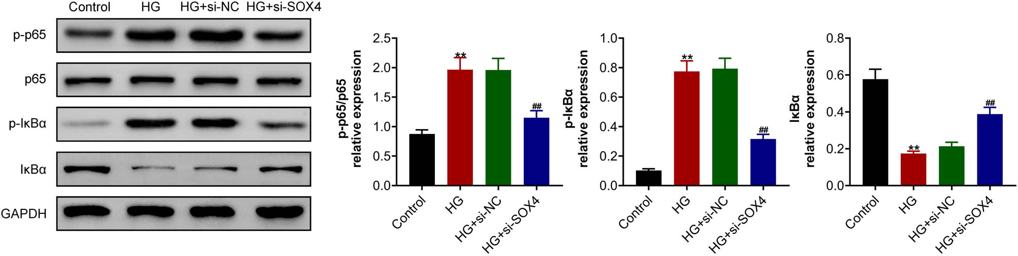 Figure 4 
                  SOX4 ablation inhibited the high-glucose-induced NF-κB signaling pathway in HRCECs. Immunoblot assay showed the expressions of the phosphorylation levels of p65 and IκBα in HRCECs upon the indicated treatment. Results are presented as mean ± SEM, HG versus control, **p < 0.01, HG + siSOX4 versus HG + siNC, ##
                     p < 0.01. HG, high glucose, NC, negative control.
               