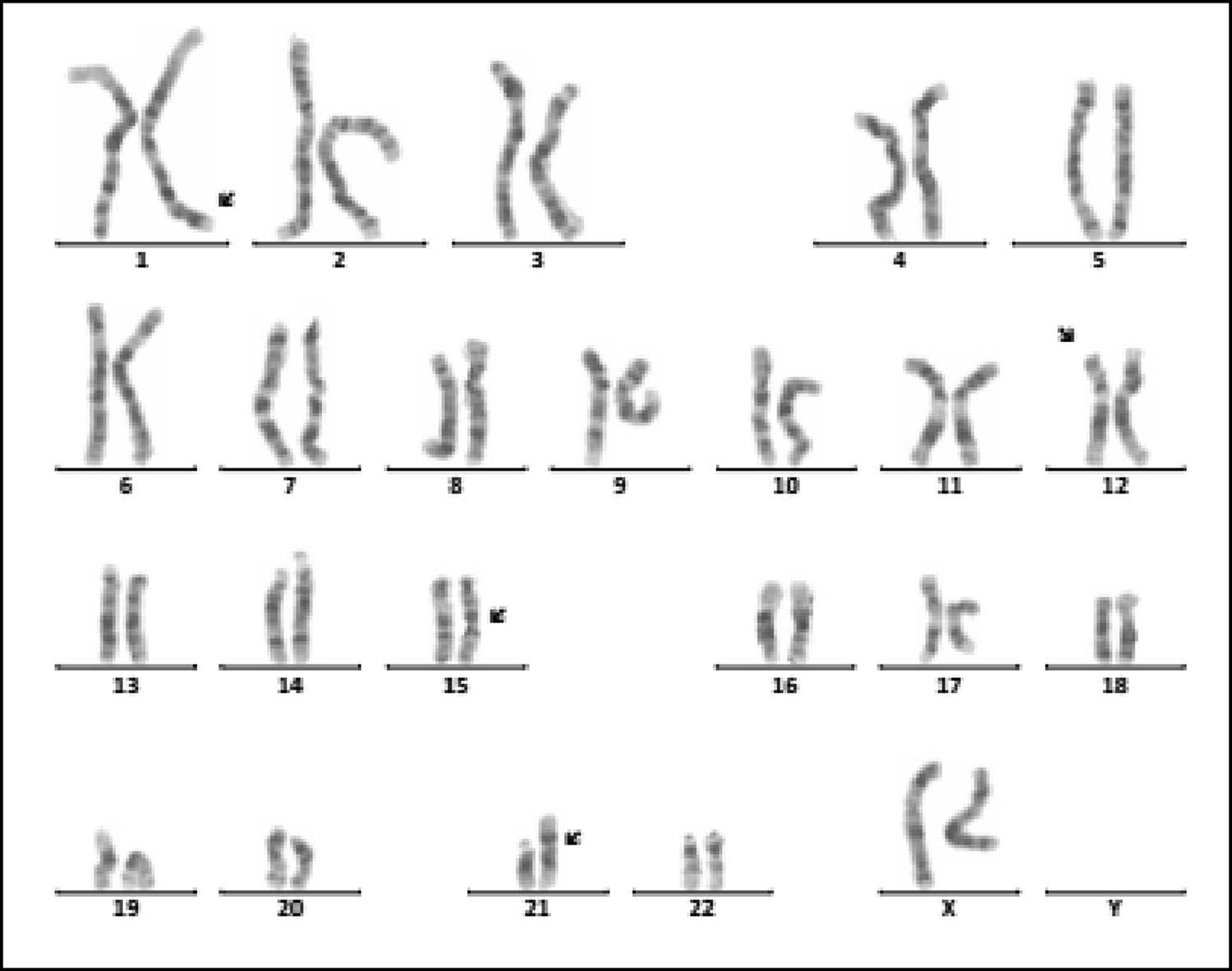 Figure 1
Karyotype of 46,XX, der(21;21)(q10;q10),t(1;12)(q43;p12.1),inv(15)(q13q24). The arrows show abnormal chromosomes.