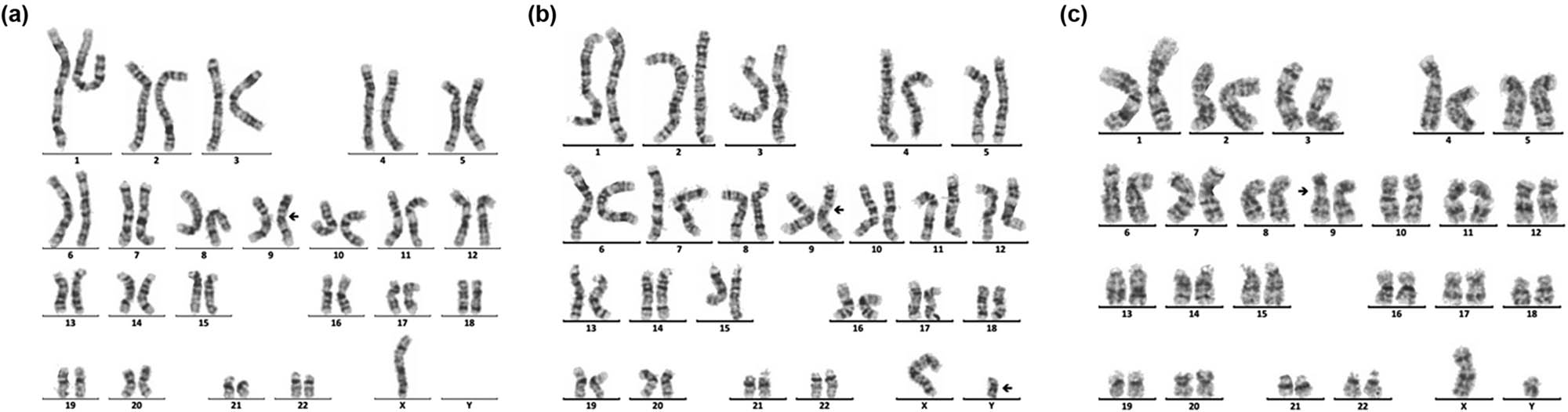 Figure 2 
               Karyotype of 45,X,inv(9)(p11q13)[72]/46,X,dic(Y)(q11.23),inv(9)(p11q13)[10]/46,XY,inv(9)(p11 q13)[4]. The arrows show abnormal chromosomes. (a) 45,X,inv(9)(p11q13). (b) 46,X,dic(Y)(q11.23), inv(9)(p11q13). (c) 46,XY,inv(9) (p11q13).
            