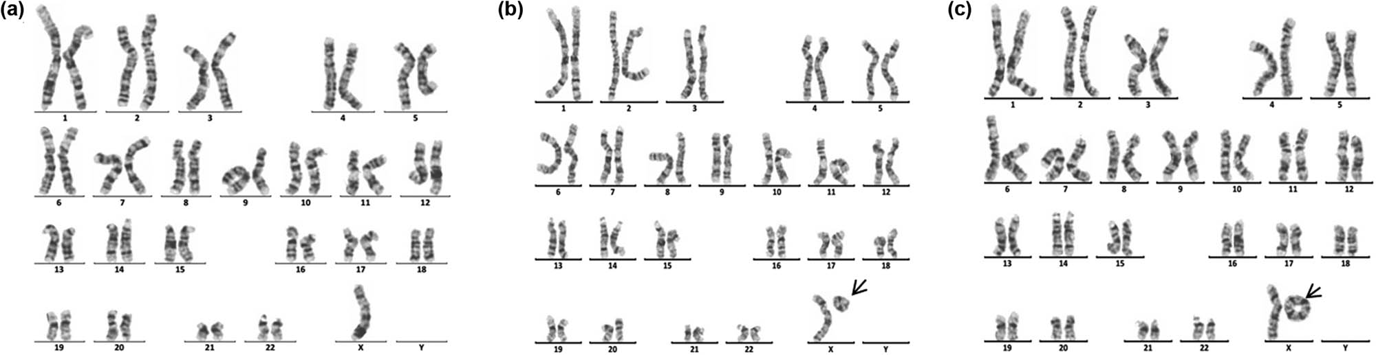 Figure 3 
               Karyotype of 45,X[120]/46,X,r(X)(p22.2q22.2)[12]/46,X,rdup(X)(p22.2q22.2)[4]. The arrows show abnormal chromosomes. (a) 45,X. (b) 46,X,r(X)(p22.2q22.2). (c) 46,X,rdup(X)(p22.2q22.2).
            