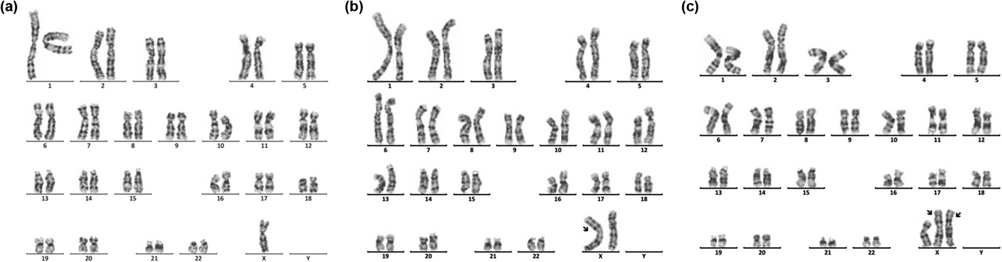 Figure 4 
               Karyotype of 46,X,idic(X)(p11.2)[92]/45,X[9]/47,X,idic(X)(p11.2),idic(X)(p11.2)[5]. The arrows show abnormal chromosomes. (a) 45,X. (b) 46,X,idic(X)(p11.2). (c) 47,X,idic(X)(p11.2),idic(X)(p11.2).
            