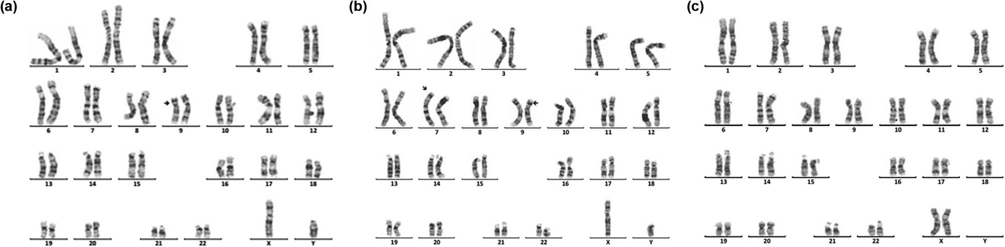 Figure 5
Karyotype of 46,XY,der(9)t(7;9)(p15;p22)pat. The arrows show abnormal chromosomes. (a) The karyotype of the patient. (b) The karyotype of the patient’s father. (c) The karyotype of the patient’s mother.