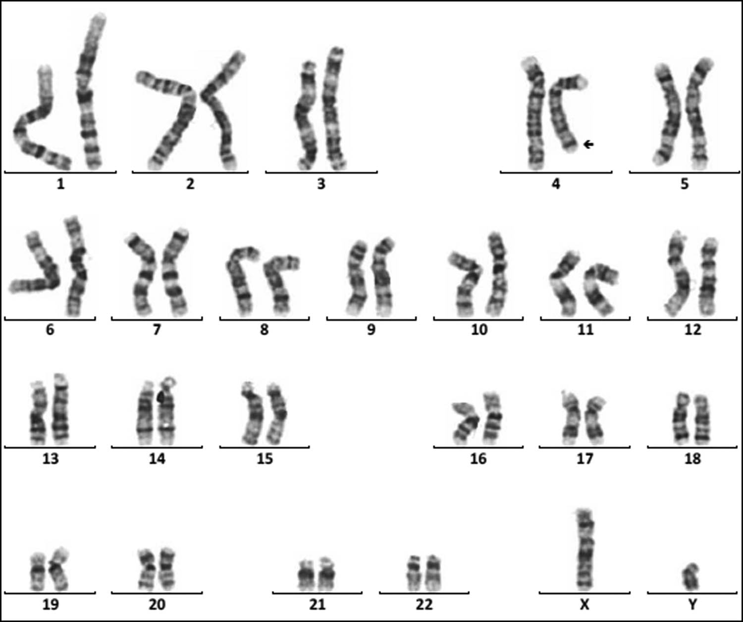 Figure 6
Karyotype of 46,XY,del(4)(q33). The arrows show abnormal chromosomes.