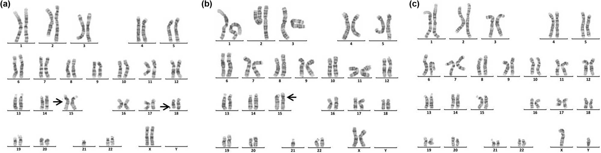 Figure 7
Karyotype of 45,XX,der(15;21)(q10;q10)mat,del(18)(q21). The arrows show abnormal chromosomes. (a) The karyotype of the patient. (b) The karyotype of the patient’s mother. (c) The karyotype of the patient’s father.