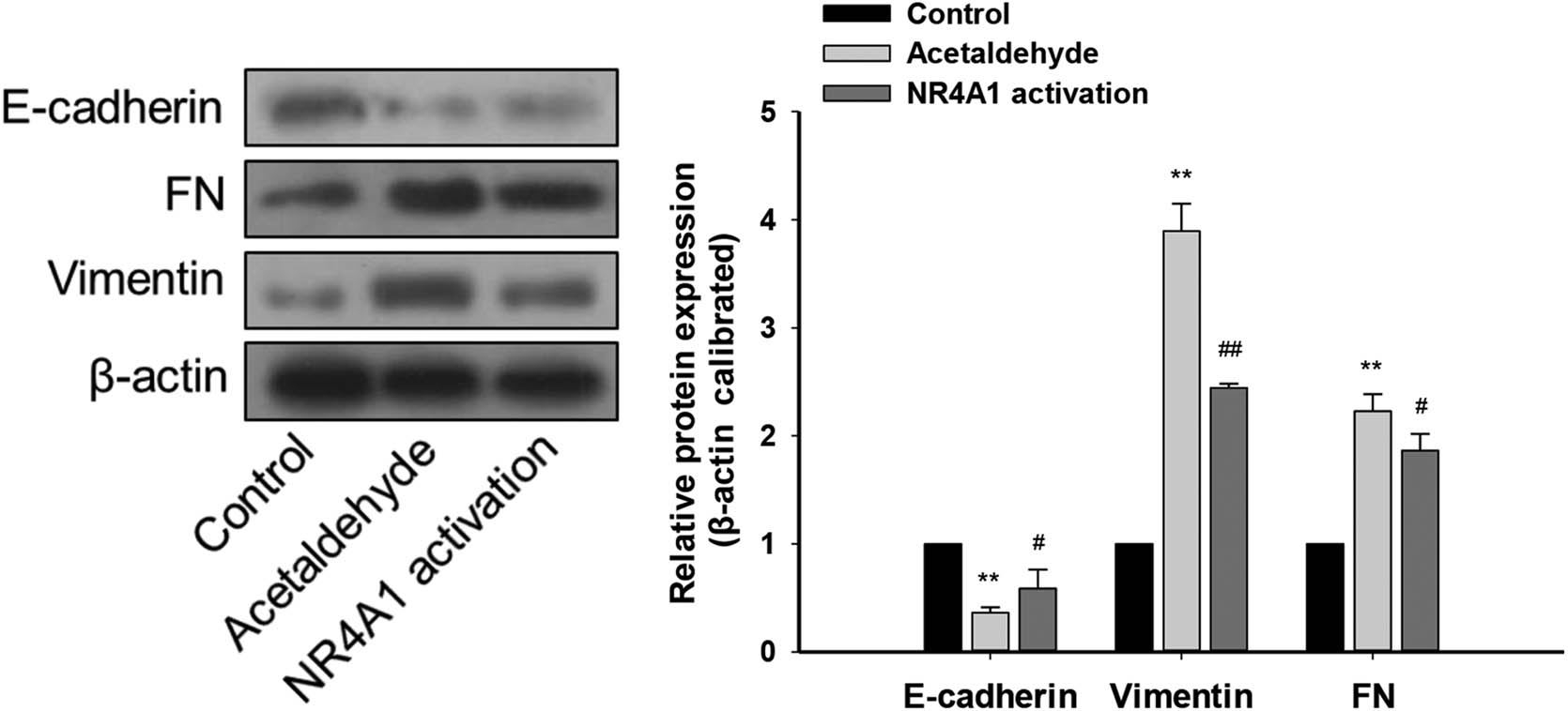 Figure 2
Effects of NR4A1 on EMT-related proteins in HSC-T6 cells. Protein levels of E-cadherin (epithelial marker) in the acetaldehyde group were downregulated, while those of FN and vimentin (mesenchymal markers) were upregulated. The protein levels of E-cadherin were upregulated in the NR4A1 activation group, while those of FN and vimentin were downregulated. The proteins were analyzed by western blotting. β-Actin was used as an internal control. **P < 0.01 vs control, #
P < 0.05, ##
P < 0.01 vs acetaldehyde. n = 3/group.