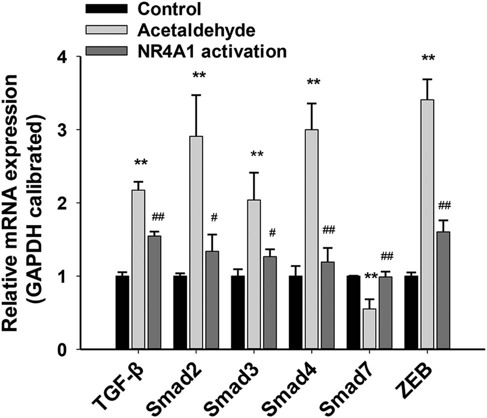 Figure 4
mRNA levels of the components of the TGF-β–Smad–ZEB signal pathway in HSC-T6 cells. The mRNA levels of TGF-β, Smad2/3/4, and ZEB were significantly upregulated, while Smad7 mRNA levels were significantly downregulated. The mRNA levels of Smad7 in the NR4A1 activation group were significantly upregulated, while those of TGF-β, Smad2/3/4, and ZEB were significantly downregulated. *P < 0.05, **P < 0.01 vs control, #
P < 0.05, ##
P < 0.01 vs acetaldehyde. n = 3/group.