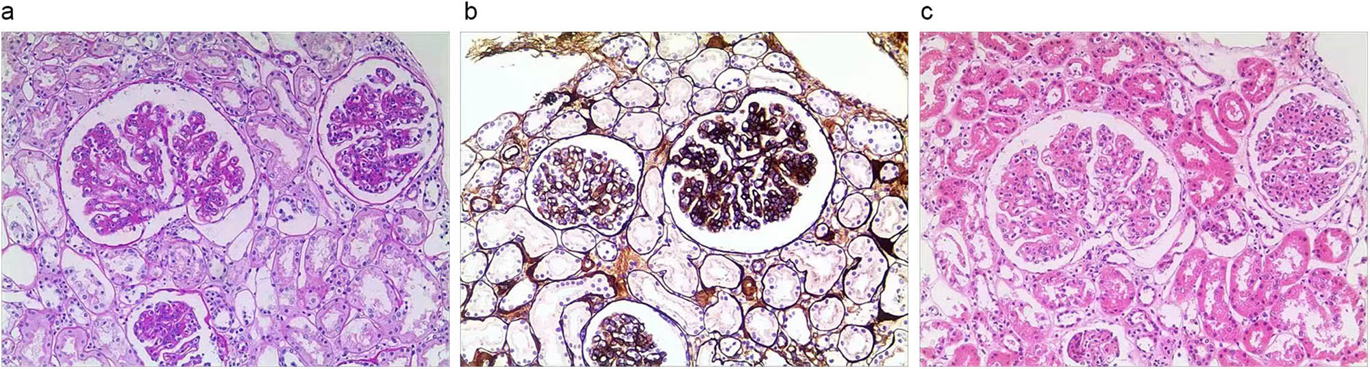 Figure 2
Representative photomicrographs of native biopsy: (a) HE, (b) Jones silver, and (c) PAS staining showed diffuse proliferation of mesangial cells and endocapillary hypercellularity.