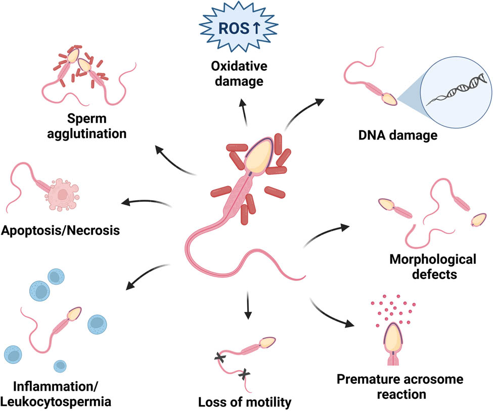 Figure 1 
               The effects of bacteriospermia on the sperm quality. The effects of bacteriospermia on sperm structure and function are distinct and multifactorial. Most reports have observed decreased sperm motility, alterations to the sperm morphology, and acrosomal degeneration. Frequently observed phenomena include DNA fragmentation and cell death. Sperm agglutination, oxidative stress, and a local immune reaction as a result of bacteriospermia have also been reported. Created with BioRender.com.
            