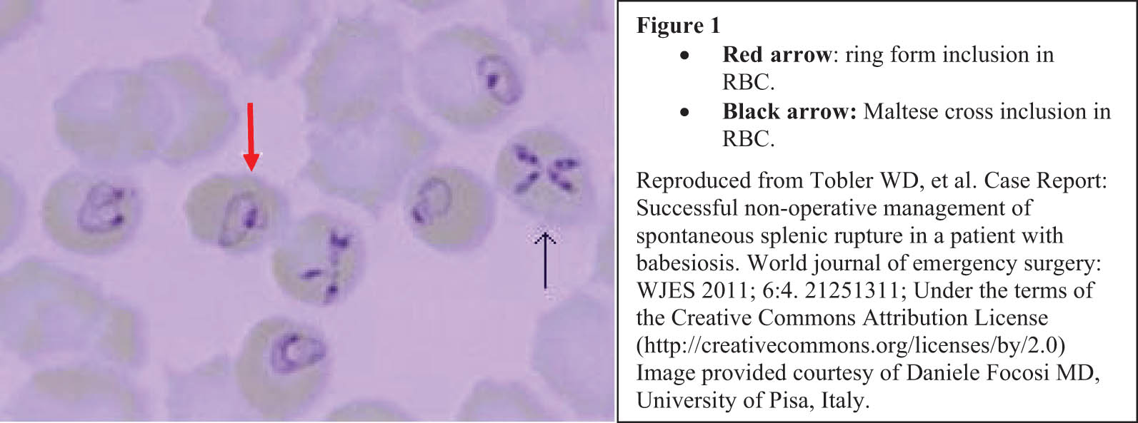 Figure 1
Ring forms and Maltese cross inclusions in erythrocytes.