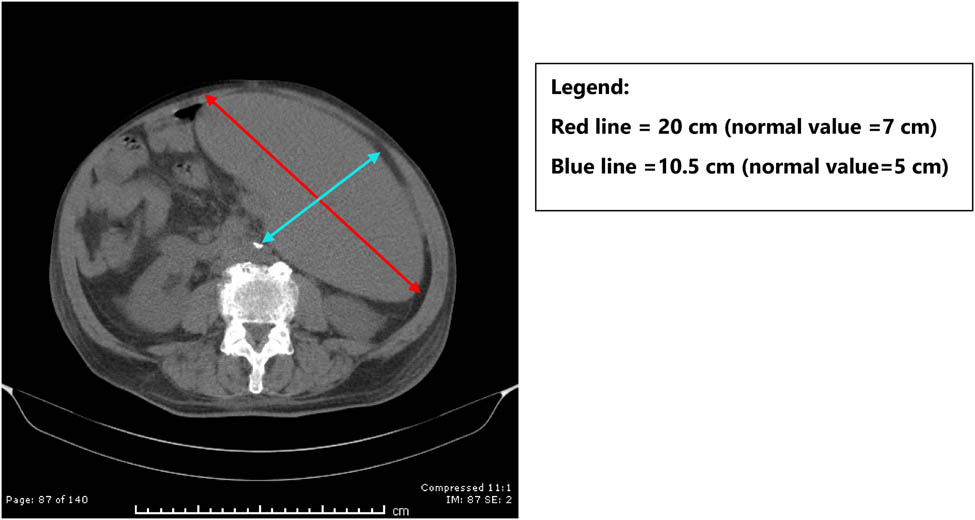 Figure 2
CT scan showing massive splenomegaly.