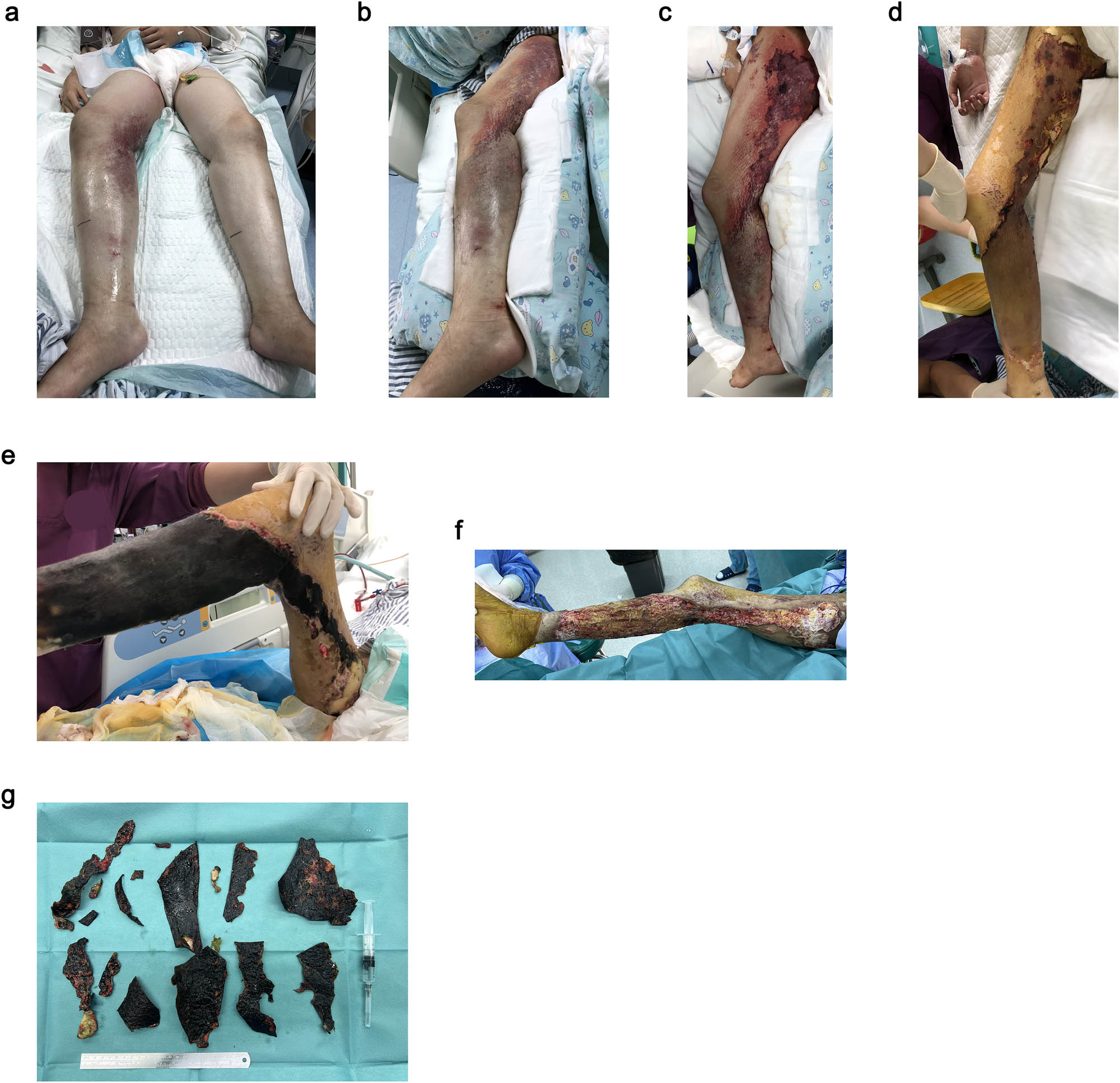 Figure 1
Soft tissue infection in the patient’s right lower limb. (a) Edema at both lower extremities, with stasis at the right side. (b) Edema alleviated, with a clear boundary between the infected areas and normal tissues. (c) Necrotizing ecchymoses at the infection site of the right lower limb. (d) Gradually drying infection site of the right lower limb. (e) Necrotizing eschars of skin at the infection site with clear boundaries. (f) Skin and subcutaneous tissue necrosis, partial tendons involved, superficial venous embolism found in the surgery. (g) Necrotic skin and tendons cut off during debridement.