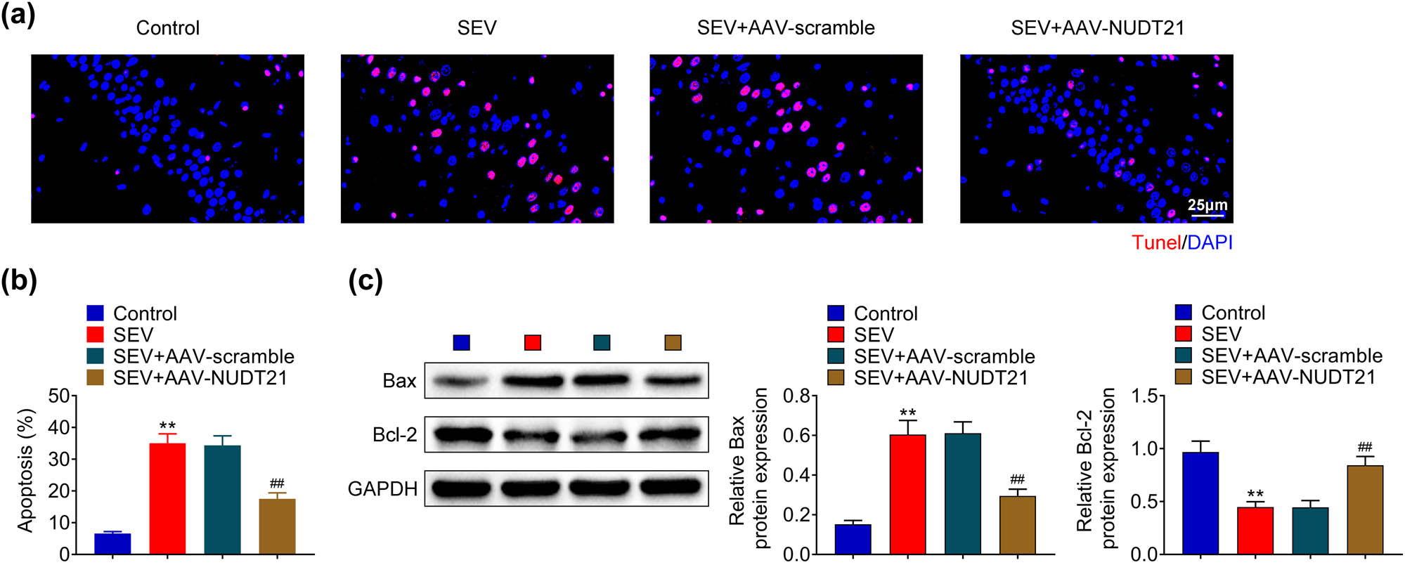 Figure 3 
                  NUDT21 ameliorated sevoflurane-induced neurons apoptosis in hippocampal tissue. (a) Hippocampal neurons apoptosis of sevoflurane-induced rats after transfected with AAV-NUDT21 was evaluated using TUNEL assay. (b) Quantitative results of apoptosis rate in hippocampal neurons of sevoflurane-induced rats after transfected with AAV-NUDT21. (c) The protein levels of Bax and Bcl-2 in hippocampal neurons of sevoflurane-induced rats after transfected with AAV-NUDT21 were detected using Western blot. **P < 0.01. ##
                     P < 0.01.
               