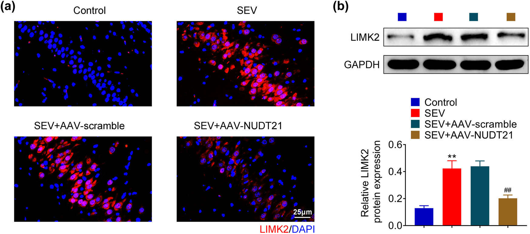 Figure 4 
                  NUDT21 down-regulates LIMK2 expression. (a) The LIMK2 expression in hippocampal tissue of sevoflurane-induced rat after transfected with AAV-NUDT21 was assessed using Immunofluorescence. (b) The LIMK2 expression in hippocampal tissue of sevoflurane-induced rat after transfected with AAV-NUDT21 was assessed by Western blot. **P < 0.01. ##
                     P < 0.01.
               