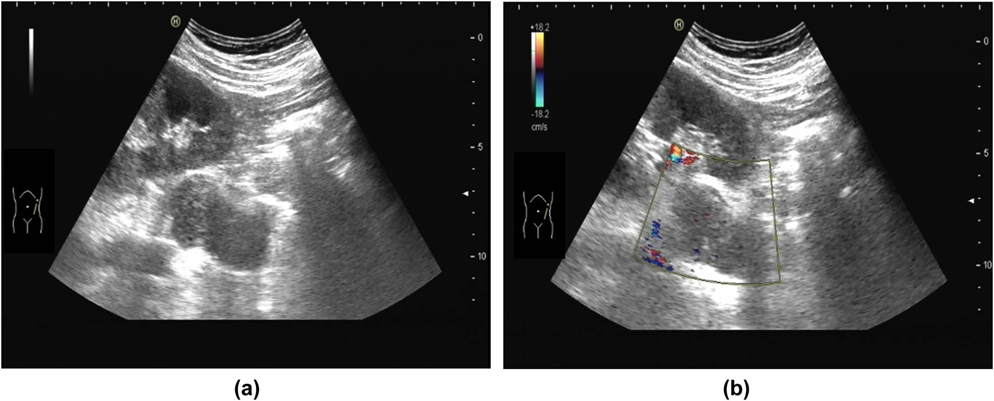 Figure 1 
               (a) Ultrasonic image: mass in the left retroperitoneum with an irregular shape and uneven internal echo. (b) Ultrasonic image: the CDFI shows no blood flow signal of the mass.
            