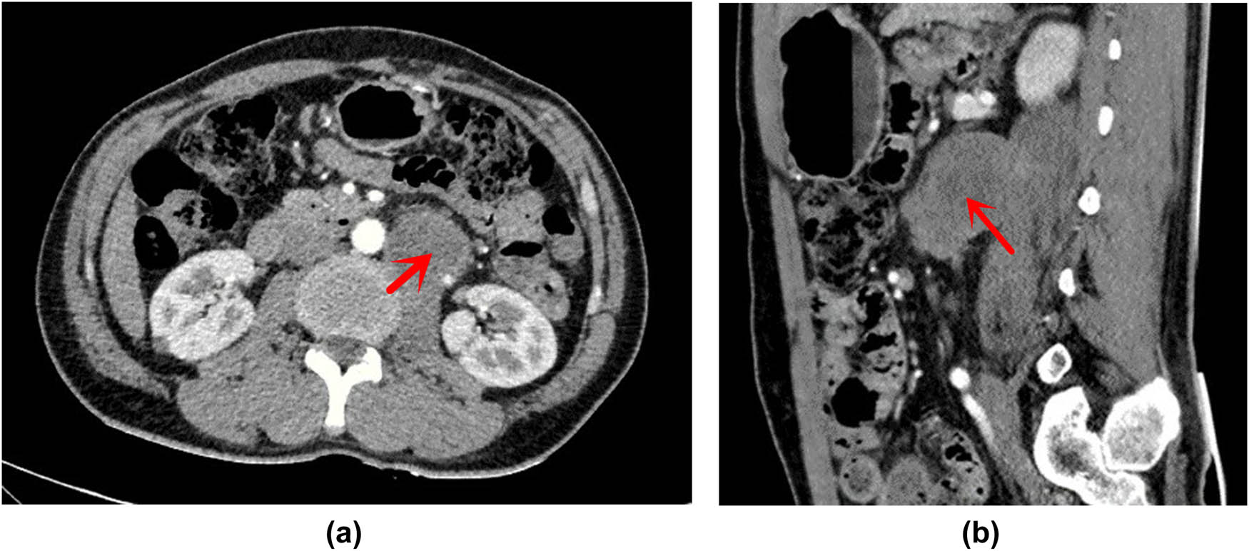 Figure 2 
               (a) Computed tomography (CT) cross section: low-density area of soft tissue mass in the front edge of the left retroperitoneal psoas major muscle. (b) The CT sagittal plane: low-density area of soft tissue mass in the front edge of the left retroperitoneal psoas major muscle.
            