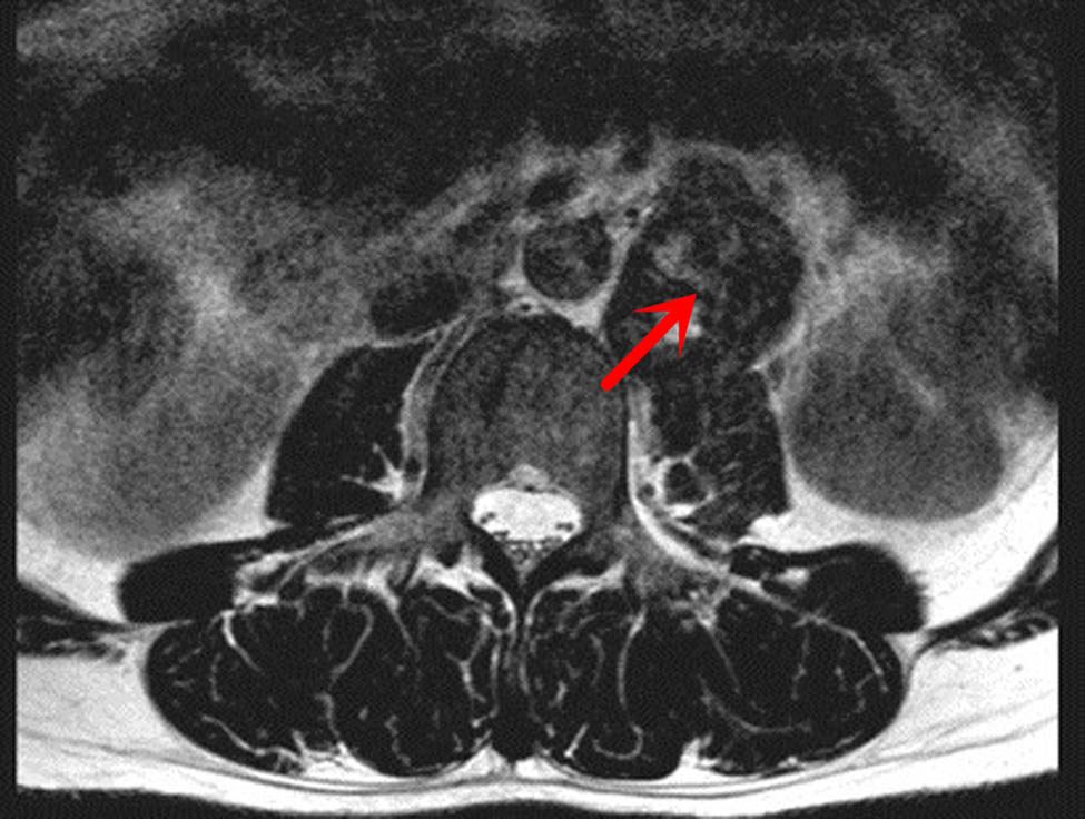 Figure 3 
               MRI T2WI cross section: quasi-circular abnormal signal area in the left front of the second and third lumbar vertebrae. The T2WI signals were mixed and had uneven enhancement.
            