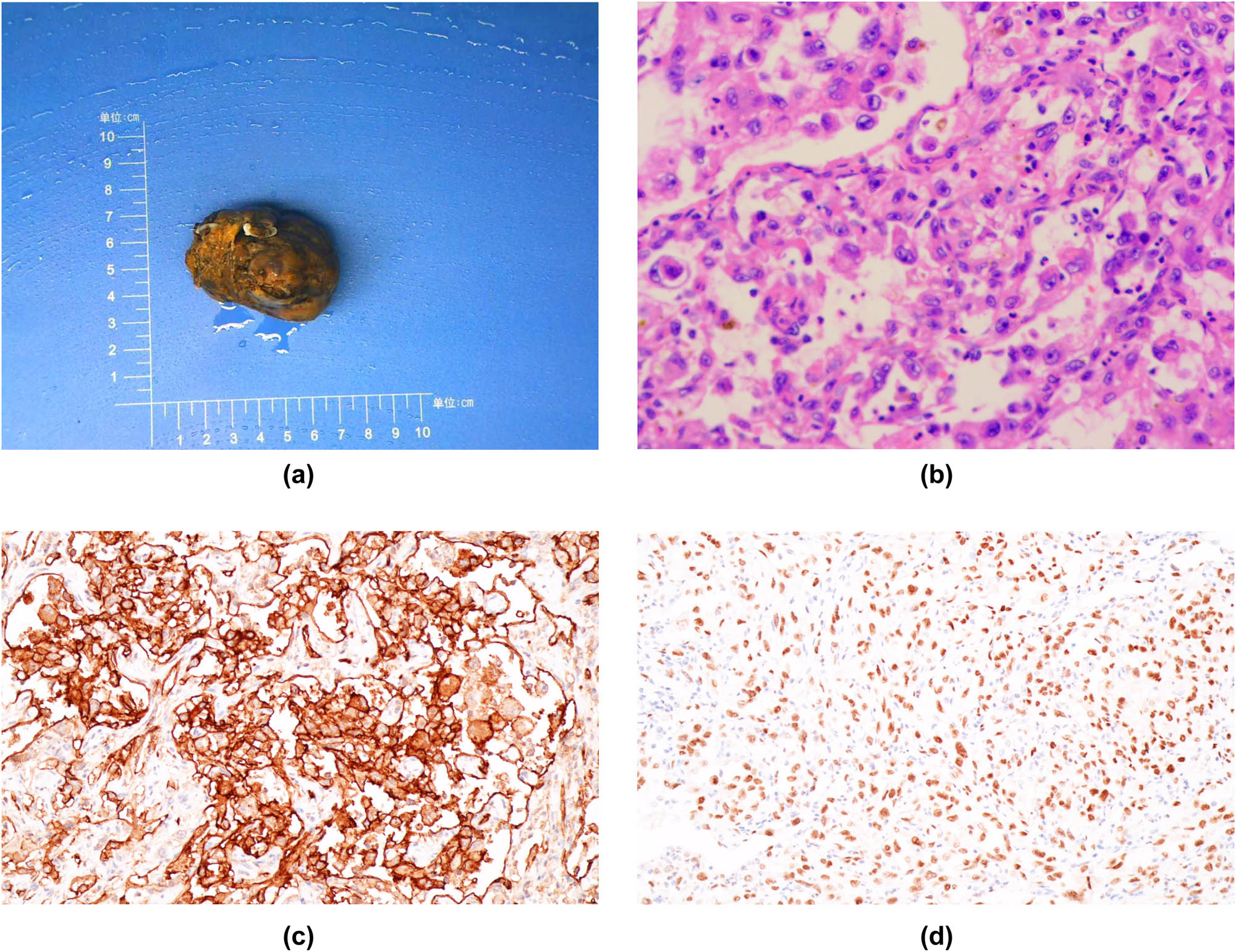 Figure 4 
               (a) Image of gross specimen: most of the left retroperitoneal tumors are grayish yellow and necrotic. (b) Histopathological image: the left retroperitoneal mass is a malignant tumor with necrosis. Tumor cells are epithelioid, with obvious cell atypia, and mitotic images are easy to visualize (hematoxylin and eosin stain × 200). (c) Immunohistochemical tumor CD31 (+). (d) Immunohistochemical tumor cell ERG (+).
            