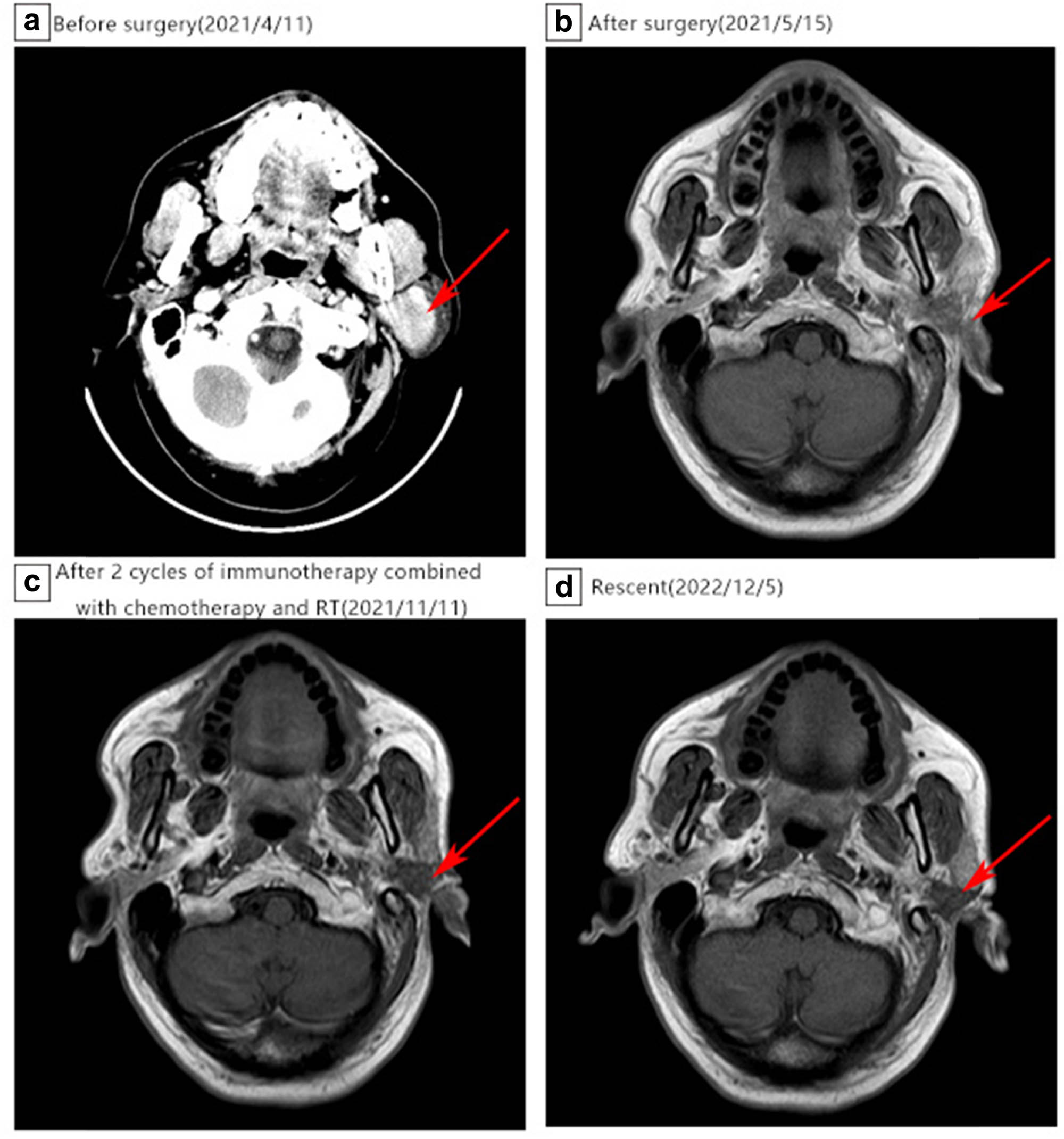 Figure 1 
               Imaging of the parotid gland. (a) CT scan before surgery, the red arrow shows a left parotid occupancy (on April 11, 2021). (b) Nuclear magnetic resonance (MRI) scan after surgery and before chemotherapy and radiotherapy (RT) (on May 15, 2021). (c) MRI scan after chemotherapy and RT (on November 11, 2021). (d) MRI scan recently (on December 5, 2022).
            