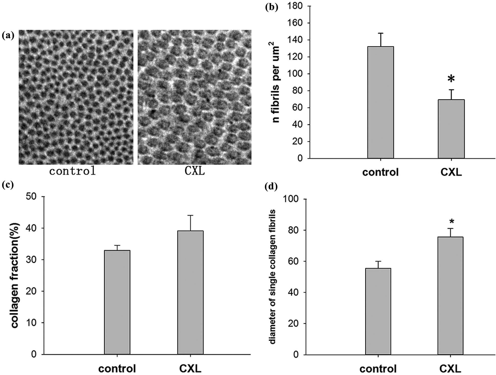 Figure 2 
                  (a) Examples of collagen fibril profiles in electron microscopy images of the conjunctiva of the control eyes and the eyes treated with UV light at an intensity of 45 mW/cm2. (b) Number of collagen fibrils per μm2 in the fibril bundles of the conjunctiva of the control eyes and the eyes treated with UV light at an intensity of 45 mW/cm2. (c) Collagen fraction (the relative area filled with collagen fibrils within the interfibrillar matrix of the conjunctiva) of the control eyes and the eyes treated with UV light at an intensity of 45 mW/cm2. (d) The diameter of single collagen fibrils in the control eyes and the eyes treated with UV light at an intensity of 45 mW/cm2 (*P < 0.05).
               