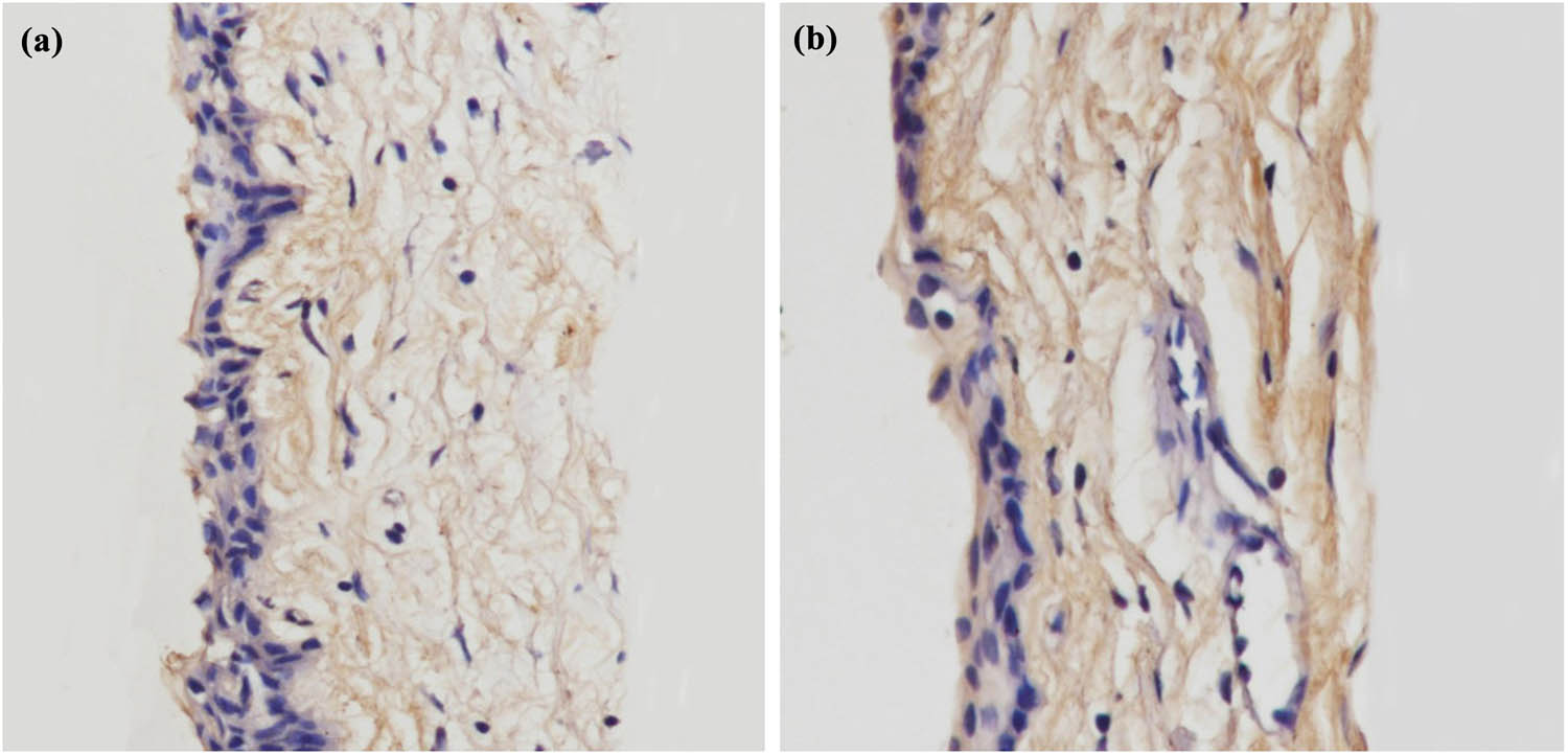 Figure 5 
                  IHC staining of frozen sections. Collagen I was found in the rabbit conjunctiva. When compared with the control group, more collagen fibers were found in the in the treatment group: (a) control group; (b) treatment group.
               