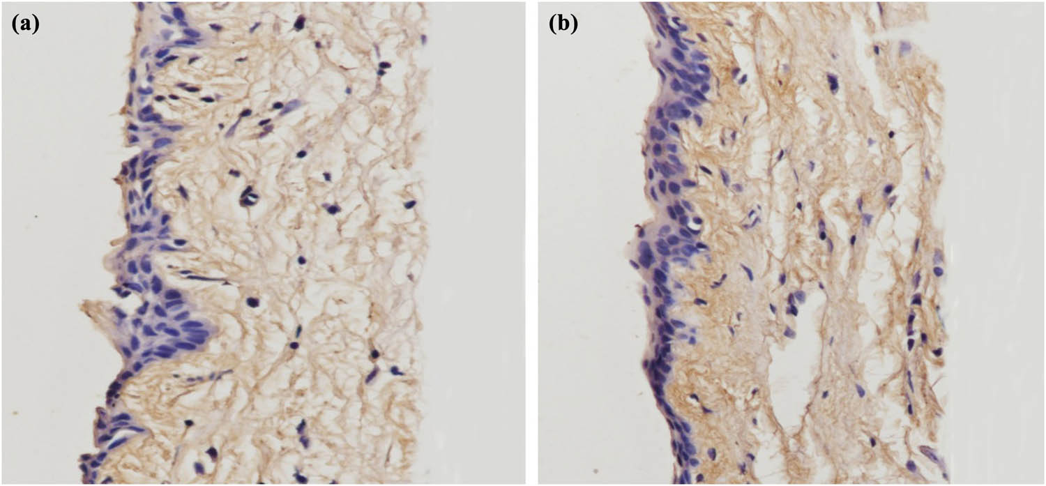 Figure 6 
                  IHC staining of frozen sections. Collagen III was found in the rabbit conjunctiva. When compared with the control group, more collagen fibers were found in the in the treatment group: (a) control group; (b) treatment group.
               