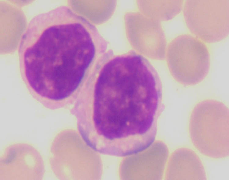 Figure 4 
                  Bone marrow smears.
               
