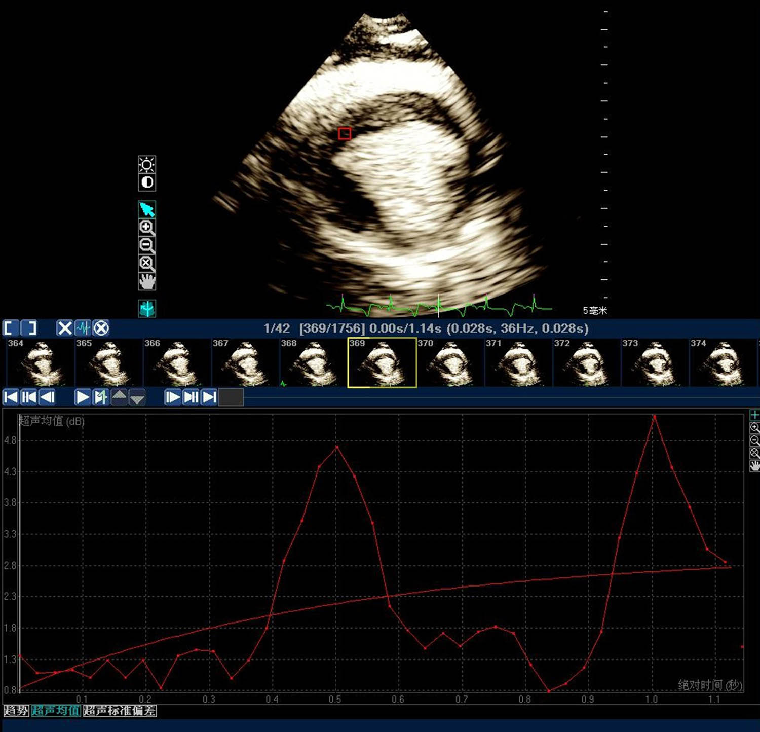 Figure 2 
                  Myocardial contrast echocardiography. After injecting the microbubble contrast agent in vivo, the acoustic signal intensity of the MI area was detected.
               