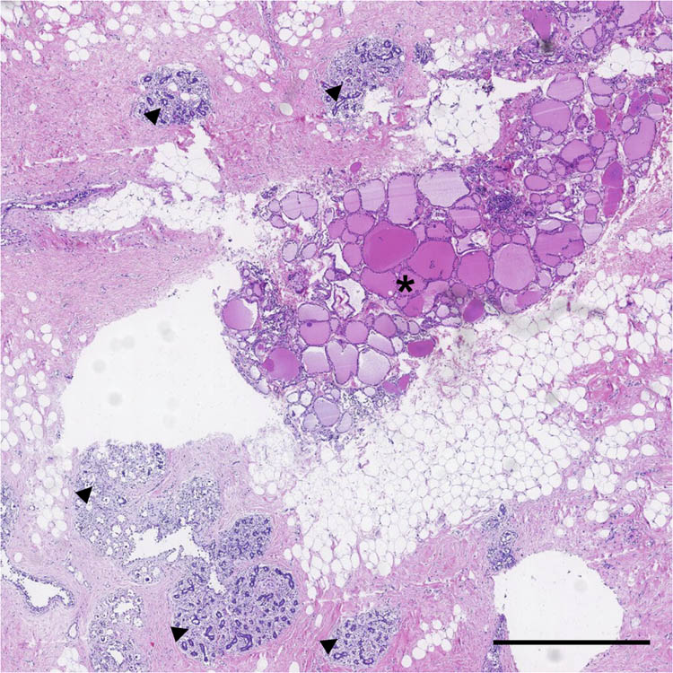 Figure 1 
               Ectopic thyroid tissue found in breast. Hematoxylin and eosin (HE) staining shows thyroid-like structure (*) and breast structure (triangles). The scale bar is 1 mm.
            