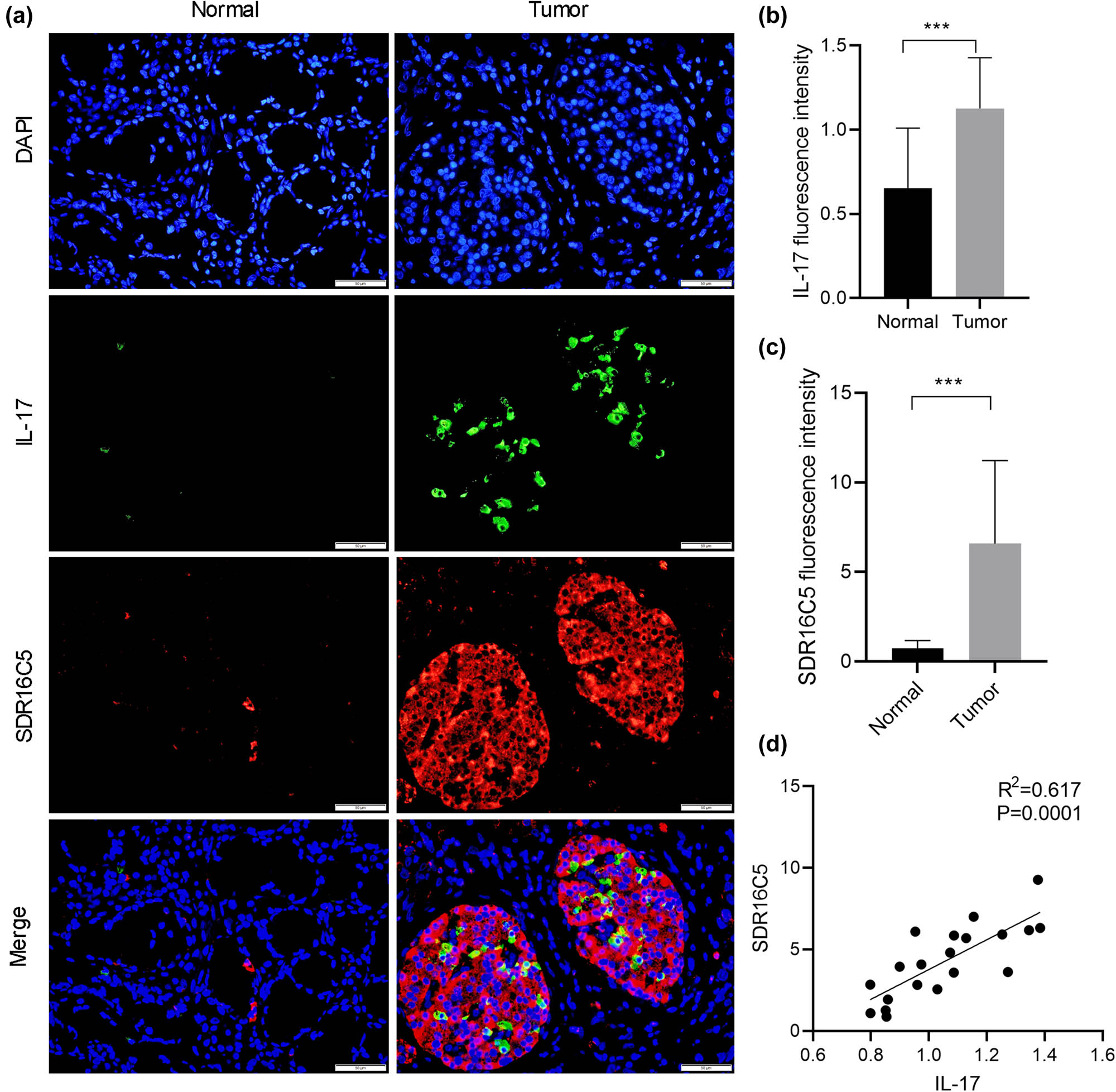 Figure 10 
                  SDR16C5 may regulate the IL-17 pathway in PAAD. Co-expression of SDR16C5 and IL-17 was measured by immunofluorescence. (a) Representative pictures of multiplex IF staining showing SDR16C5, IL-17, and DAPI (top panels) staining in PAAD tissues. Scale bars represent 50 µm. (b and c) Quantification analysis of SDR16C5 and IL-17 measured in terms of mean fluorescence density. (d) Correlation analysis between SDR16C5 and IL-17. Experiments were repeated three times with three replicates of each sample. *P < 0.05, **P < 0.01, ***P < 0.001.
               