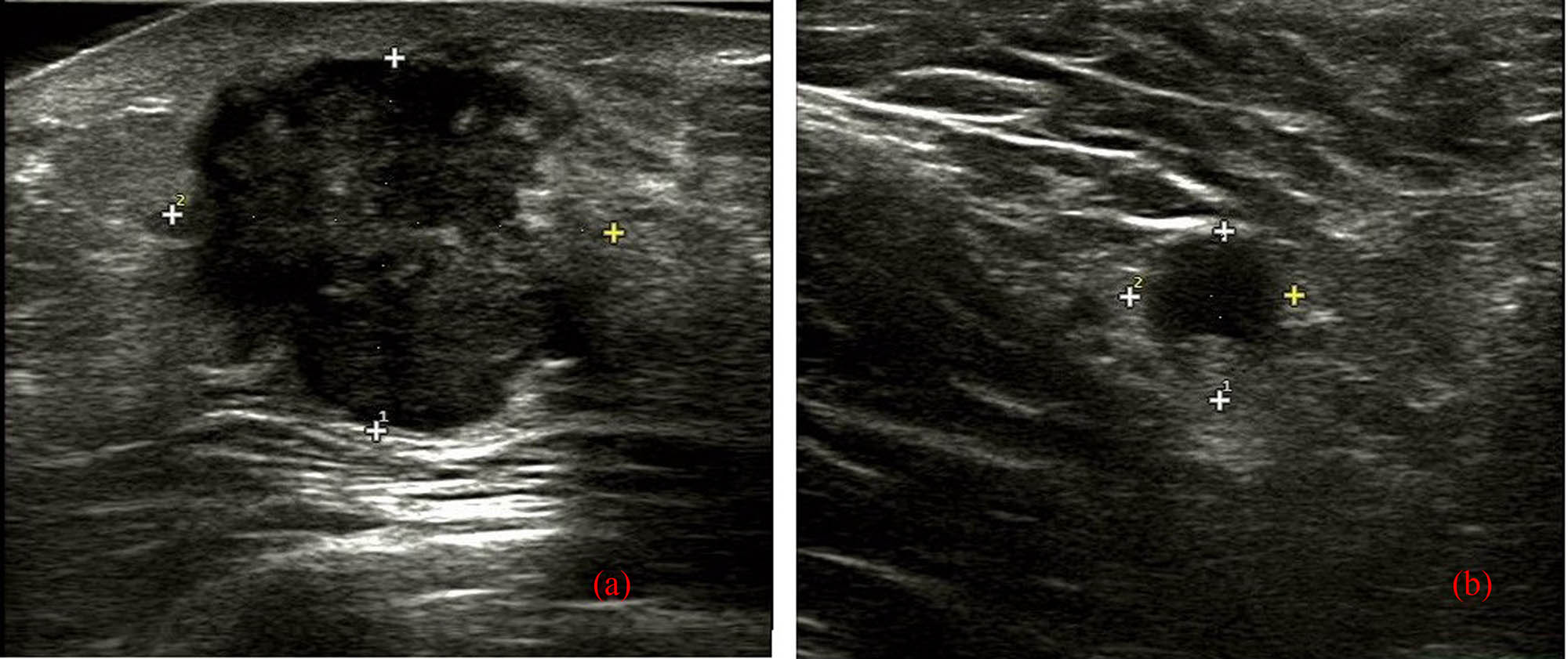 Figure 1 
               US of MBC with osseous differentiation. US revealed that there was an uneven hypoechoic mass at 9 o’clock near the nipple, with unclear boundary, irregular shape, and posterior acoustic enhancement, and few blood flow signals inside, but without definite calcifications (a) and the suspected enlarged lymph node with a slightly thickened cortical area at the right axillary region (b).
            