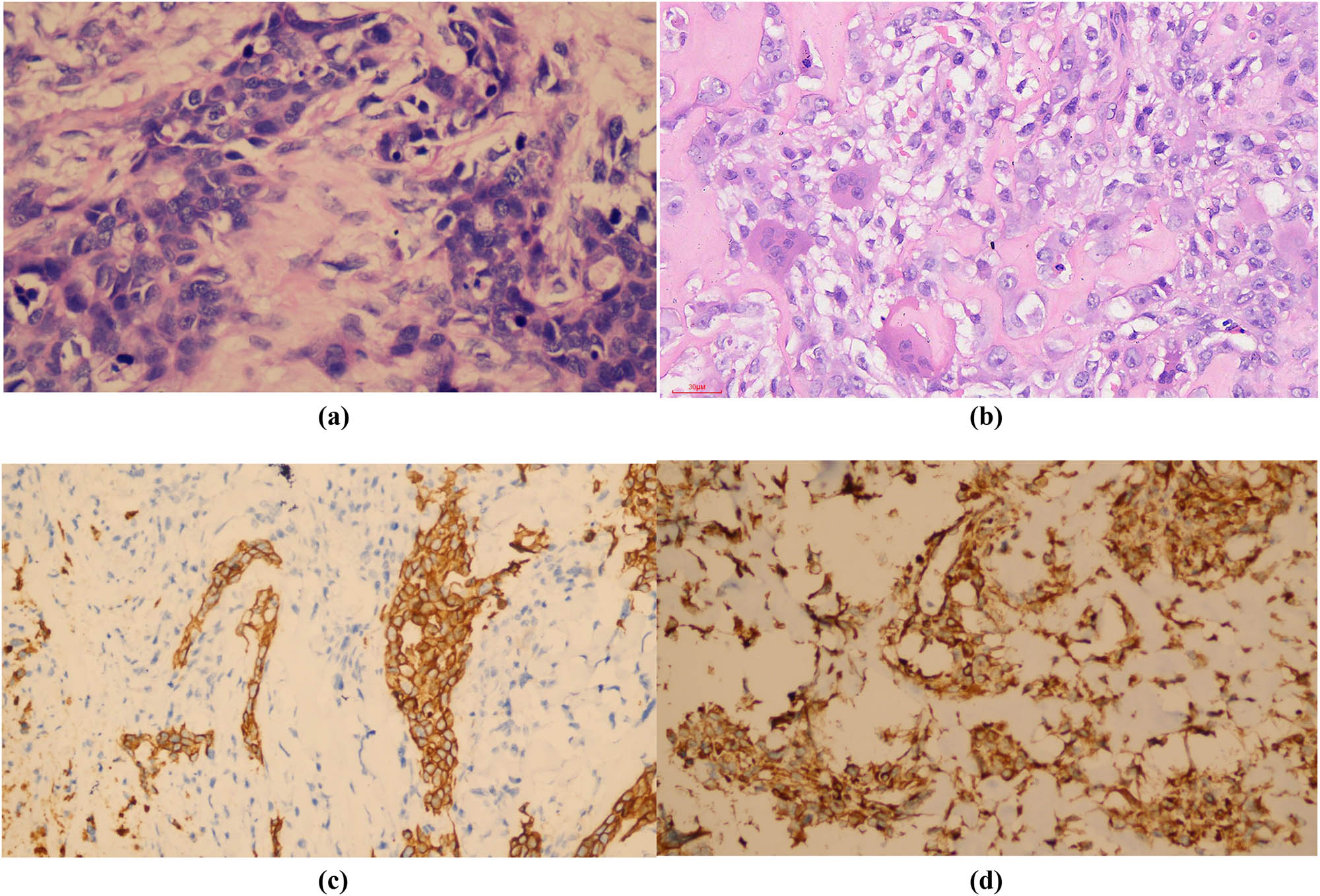 Figure 2 
               Pathological pictures of MBC with osseous differentiation, excision specimen. Images (a) and (b) showed components of typical IDC (a [20×]) and osteosarcoma (b [20×]). Images (c [10×]) and (d [20×]) showed immunohistochemistry of CK-P and vimentin staining, respectively; both were positive.
            