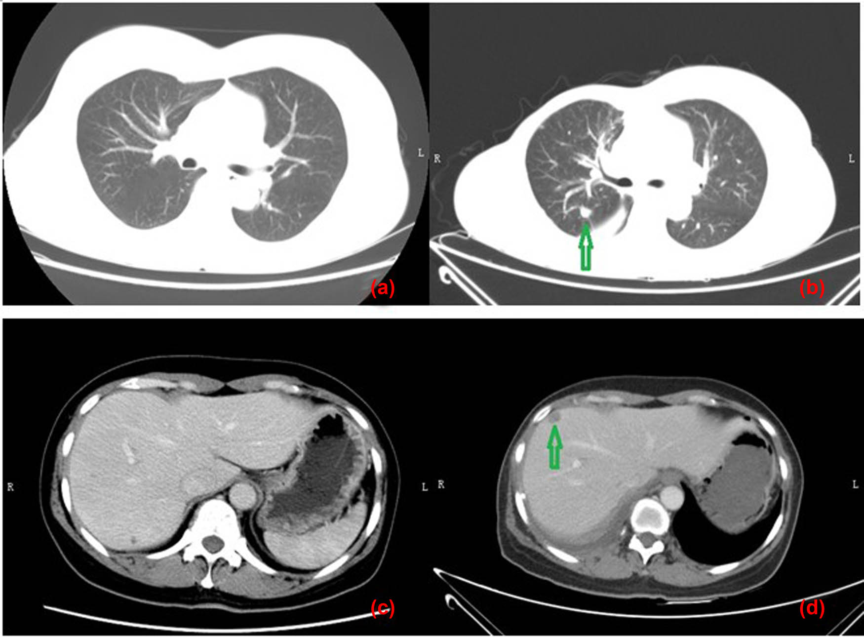 Figure 3 
               Comparing CT plans of the lung and liver before the modified radical mastectomy and 24 months after the surgery. Images (a) and (c) were CT plans of the lung and liver before the modified radical mastectomy, respectively, and revealed no metastases. Images (b) and (d) were the corresponding plans 24 months after the surgery, and metastases were indicated by the green arrows.
            