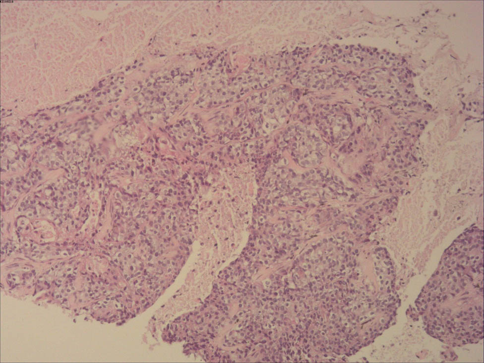 Figure 4 
               Histopathology of lung nodule (10×). This picture showed that lung nodule was metastasized from breast invasive carcinoma.
            