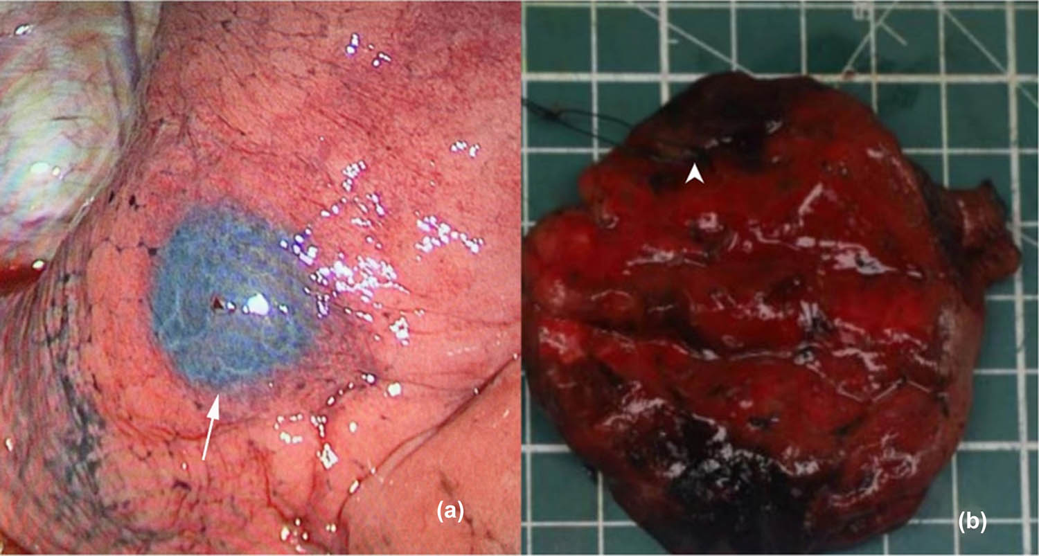 Figure 1 
                  Representative images before and after operation. (a) The markers appeared bule-purple on thoracoscopy (as the white arrow points); (b) after dissection, the gray-white nodules were marked with a line (as the white arrow points).
               