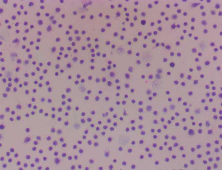 Figure 1
Examination of the pleural effusion showed massive lymphocytes, and no obvious heterotypic epithelial cells were detected.