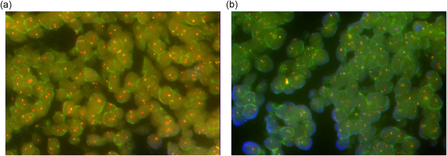 Figure 4
Molecular pathology of the tumor was detected by FISH. (a and b) Molecular pathology indicated EWSR1 rearrangement. The percentage of cells with EWSR1 breakage (red and green signal points separated) in the visual field was approximately 71%.