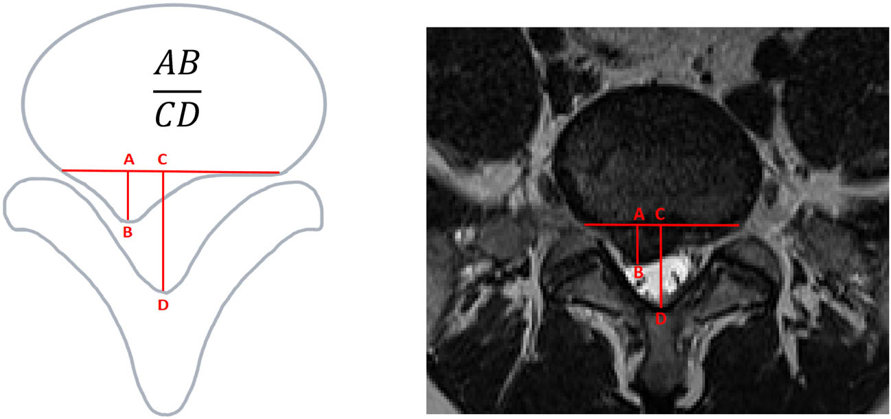 Figure 4 
                     Sagittal diameter index (SI).
                  