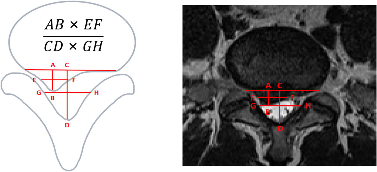 Figure 5 
                     Sagittal diameter/transverse diameter index.
                  