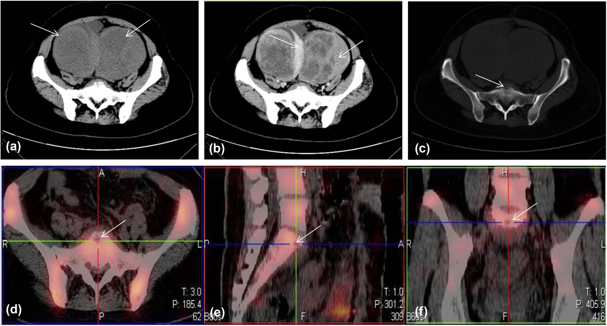 Figure 1 
               Whole abdomen CT (a–c) and radionuclide bone scintigraphy (d–f). (a) Plain abdominal CT scan. Arrows indicate two enlarged ovarian tumors with uneven density at two sides of the uterus. (b) Enhancement phase of full abdominal CT. The boundary and solid portion of the two ovarian tumors are enhanced in the arterial phase. (c) Bone window showed a discontinuous border and soft tissue density mass in front of the sacral promontory, indicating lesion invasion. (d–f) Radionuclide bone scintigraphy also showed focal radionuclide concentration of the first sacrum at transverse and median sagittal and coronal sections.
            