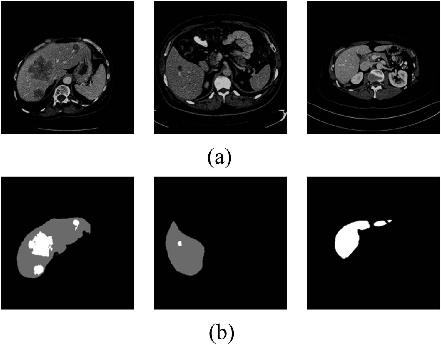 Figure 5 
                  Example of experimental dataset. (a) Abdominal CT image and (b) ground truth for liver tumor segmentation.
               