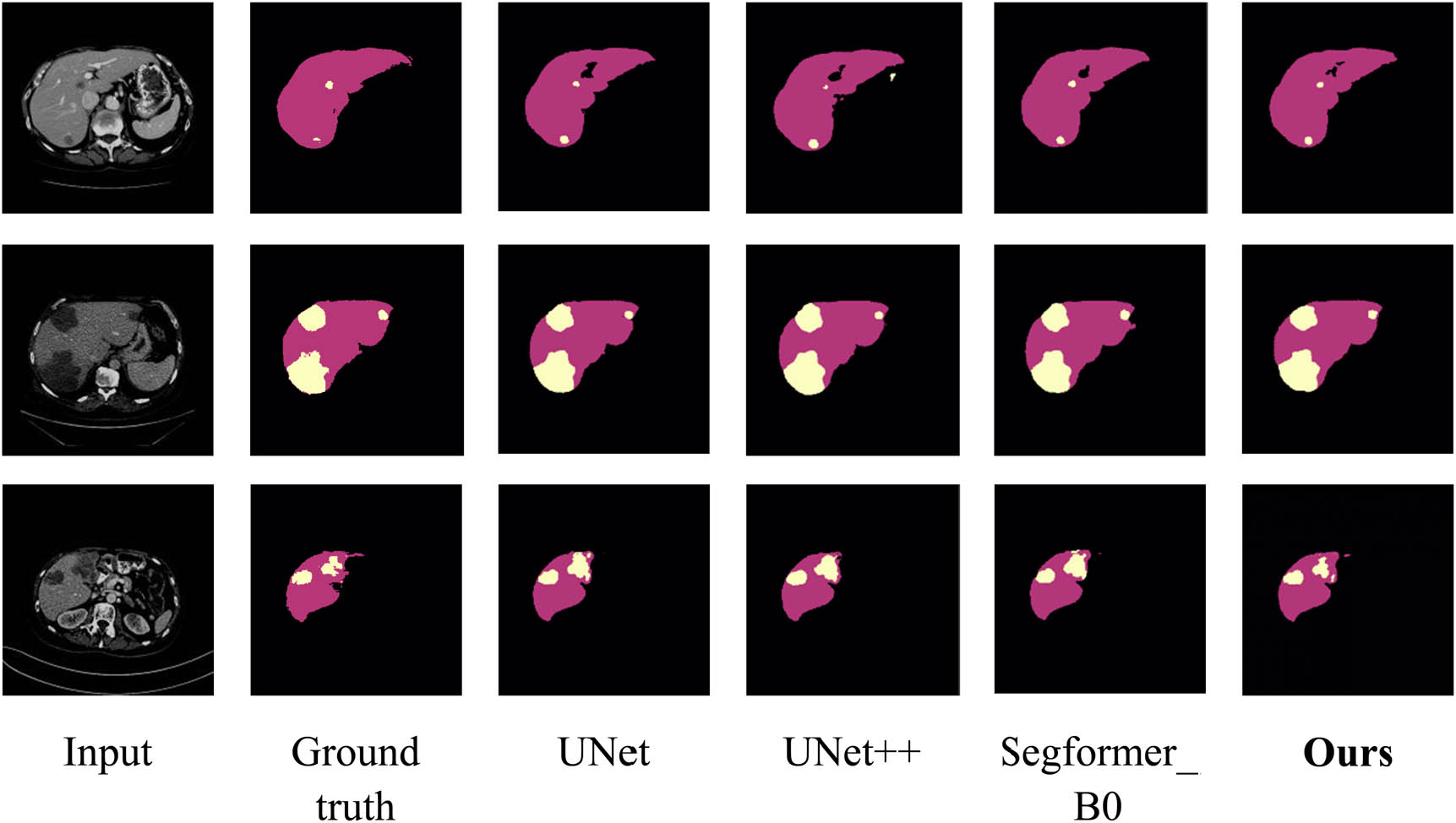 Figure 6 
                  Visual comparison of liver tumor segmentation results with different networks.
               